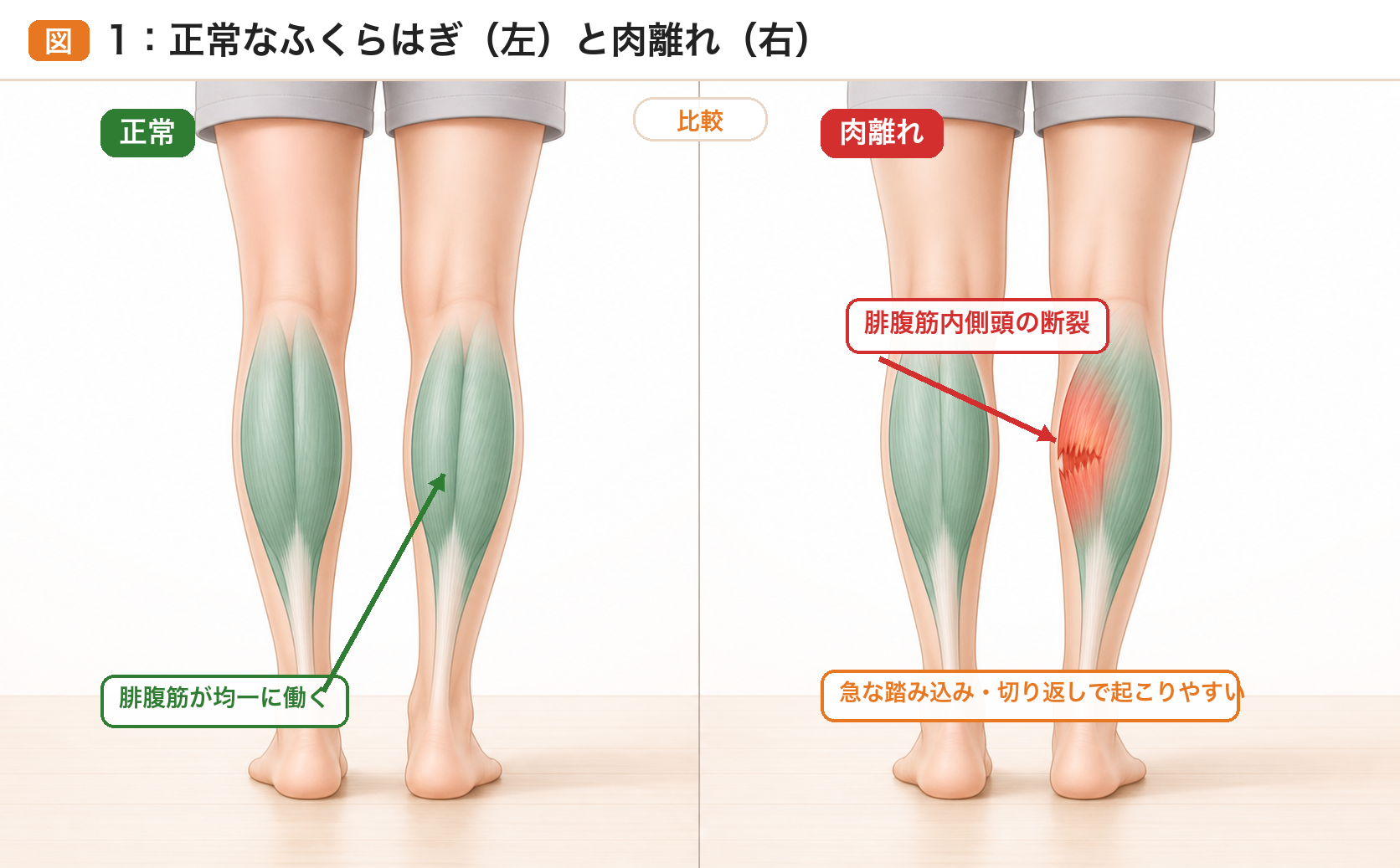 正常なふくらはぎと腓腹筋内側頭の肉離れを比較したイラスト