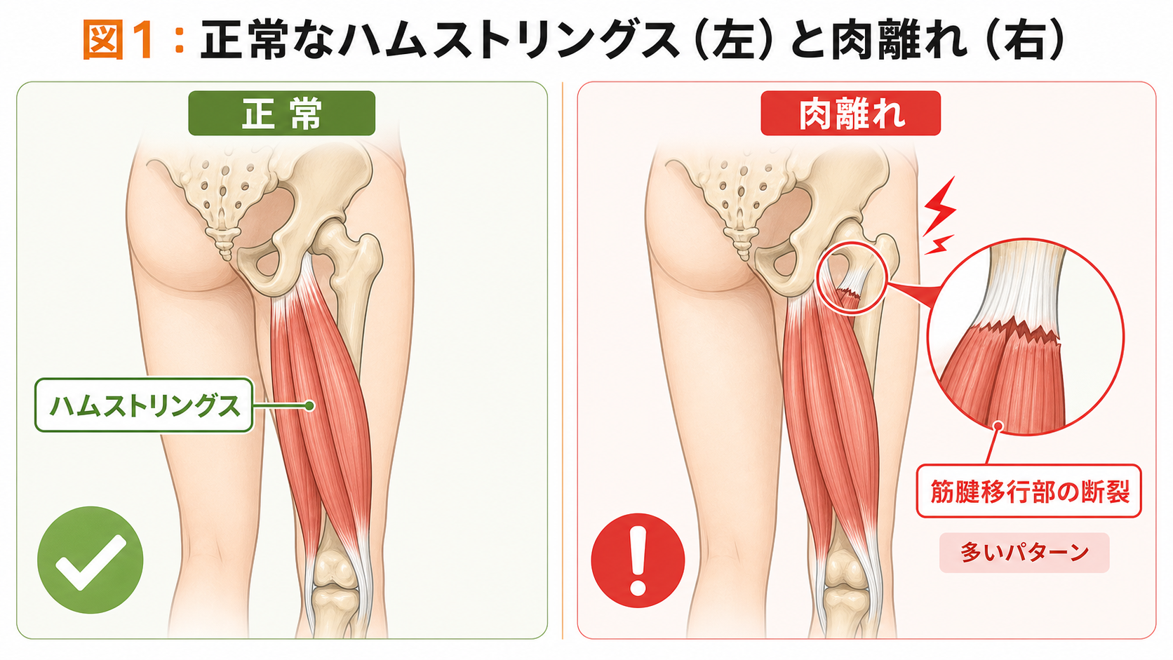 図1：正常なハムストリングスと肉離れの比較。筋腱移行部での断裂が多いパターンを示した患者向けイラスト。
