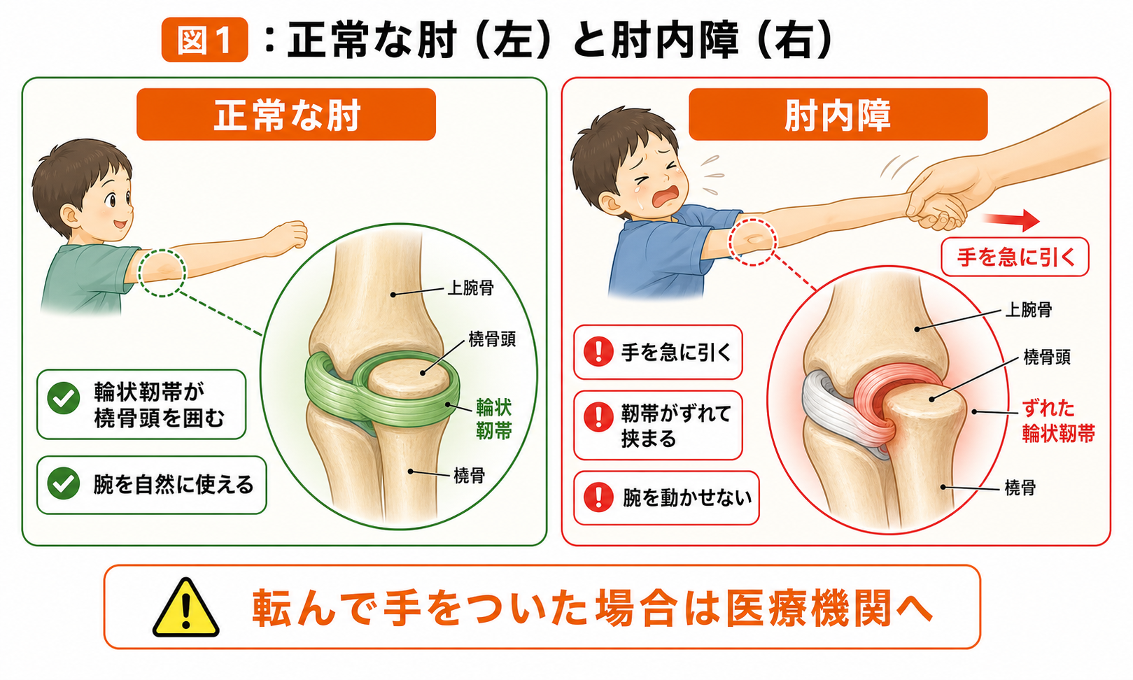 図1：正常な肘と肘内障。輪状靱帯が橈骨頭を囲む正常な状態と、手を急に引いて靱帯がずれて挟まる状態の比較イラスト。