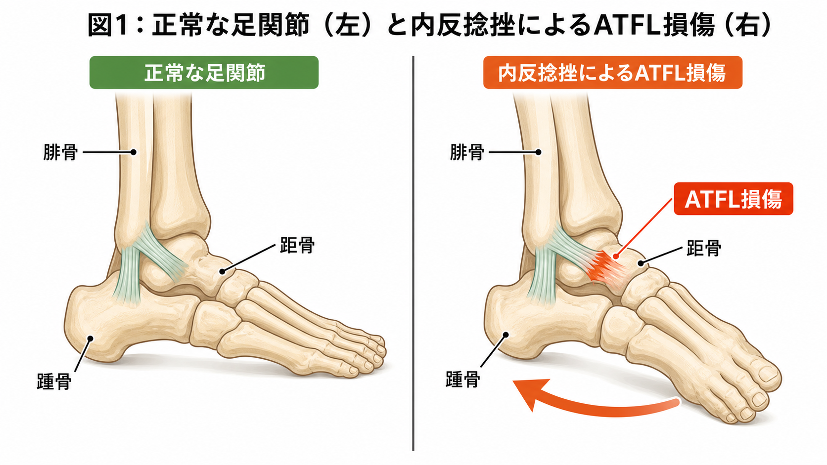図1：正常な足関節と内反捻挫によるATFL損傷の比較イラスト