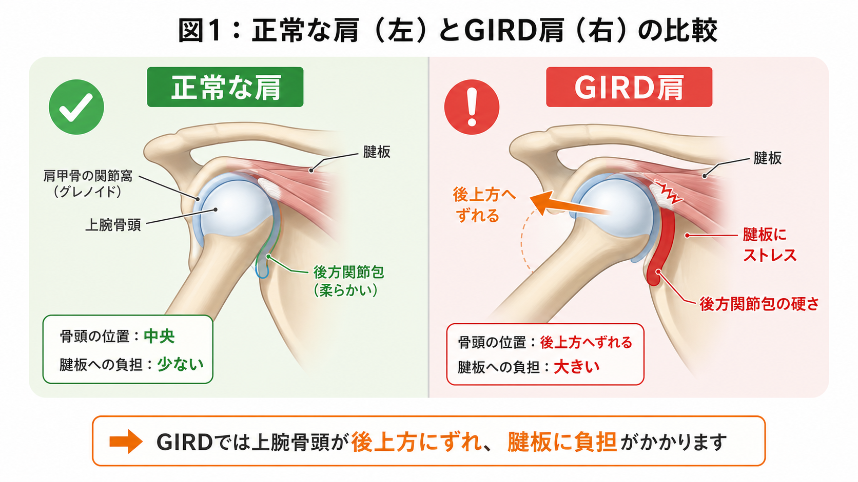 図1：正常な肩（左）とGIRD肩（右）の比較。GIRDでは上腕骨頭が後上方にずれ腱板にストレスがかかります。