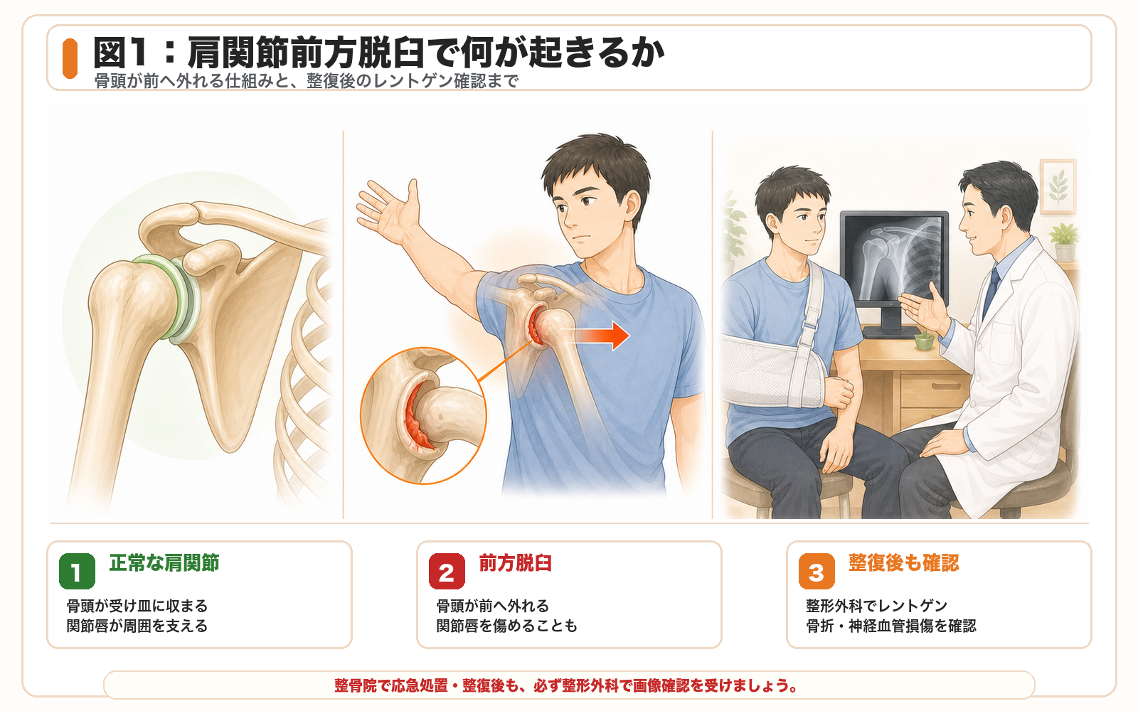 図1：肩関節前方脱臼で何が起きるか。正常な肩関節、前方脱臼、整復後も整形外科でレントゲン確認が必要な流れ。